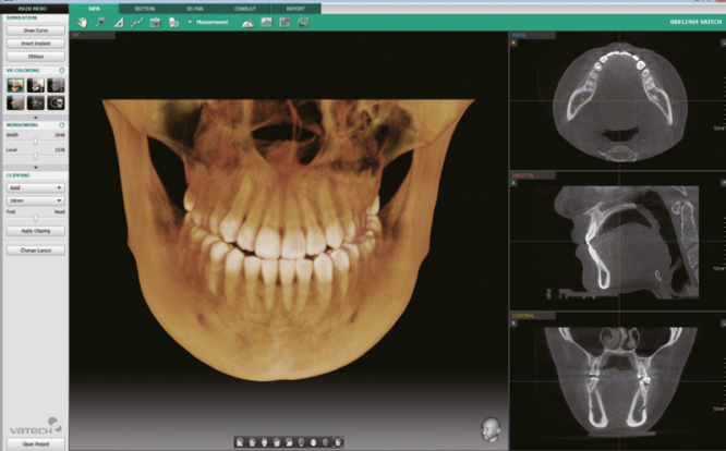 Аппарат рентгеновский дентальный цифровой панорамный¶Smart Plus с функцией компьютерного томографа и¶цефалостатом с принадлежностями